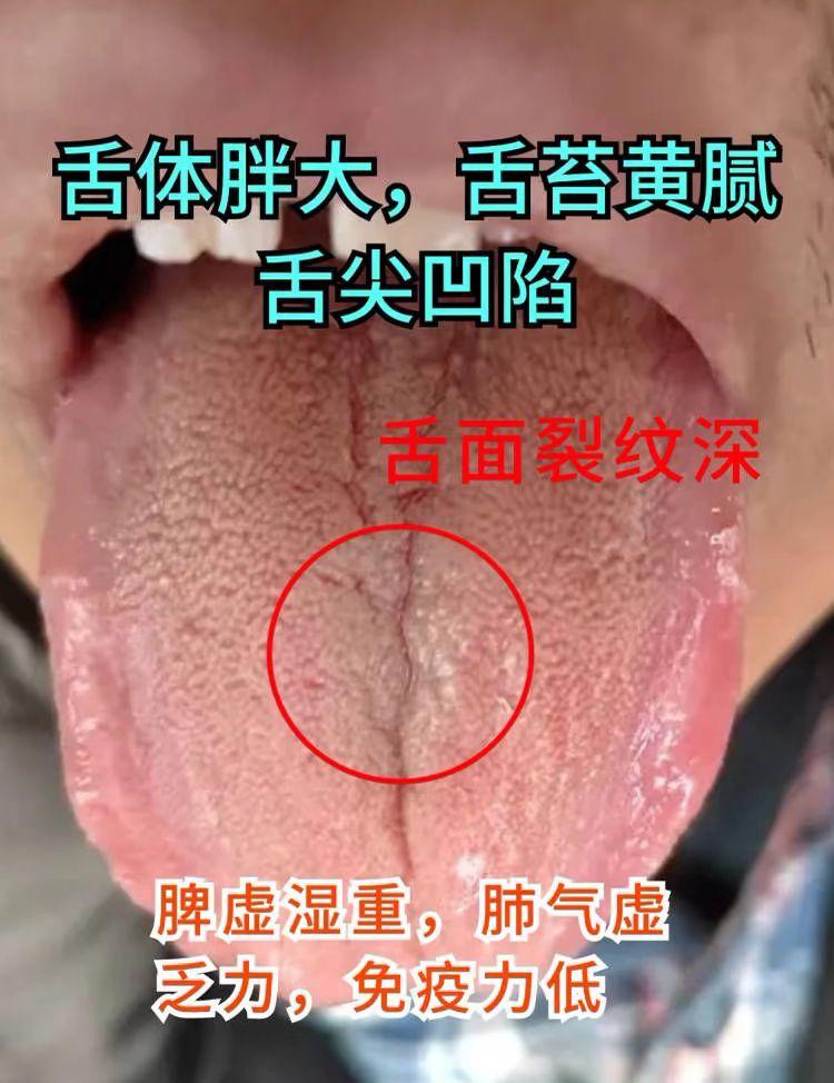 昨日看了三位粉丝朋友的舌苔 你是哪一种