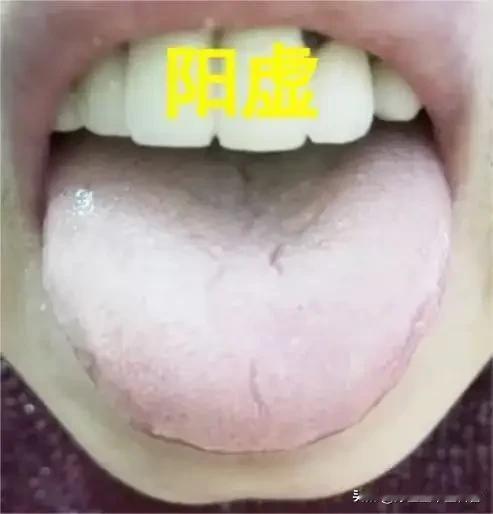 阳虚裂纹舌：阳衰湿阻失濡养，温阳化湿才是治本之法
 
阳虚裂纹舌是中医阳虚湿滞证