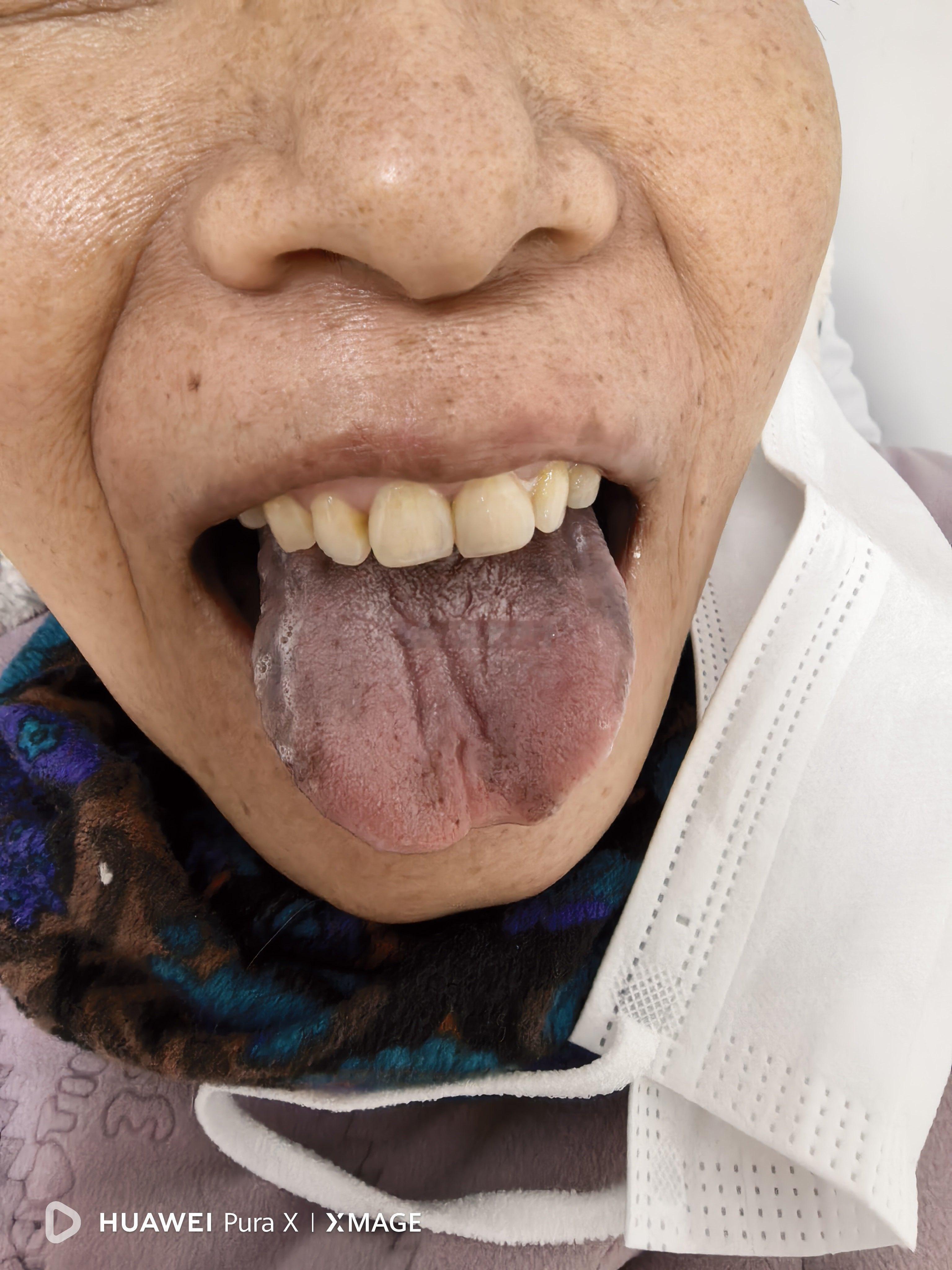 腹部肿瘤术后又转移的患者，不能食，腹痛，失眠，这是针刺治疗几天后拍的舌头照片，原