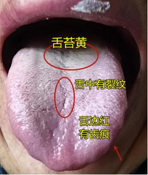 今天遇到的这个患者阴囊潮湿，房市差，时间短，没快感，稍微运动一下就累的气喘吁吁，