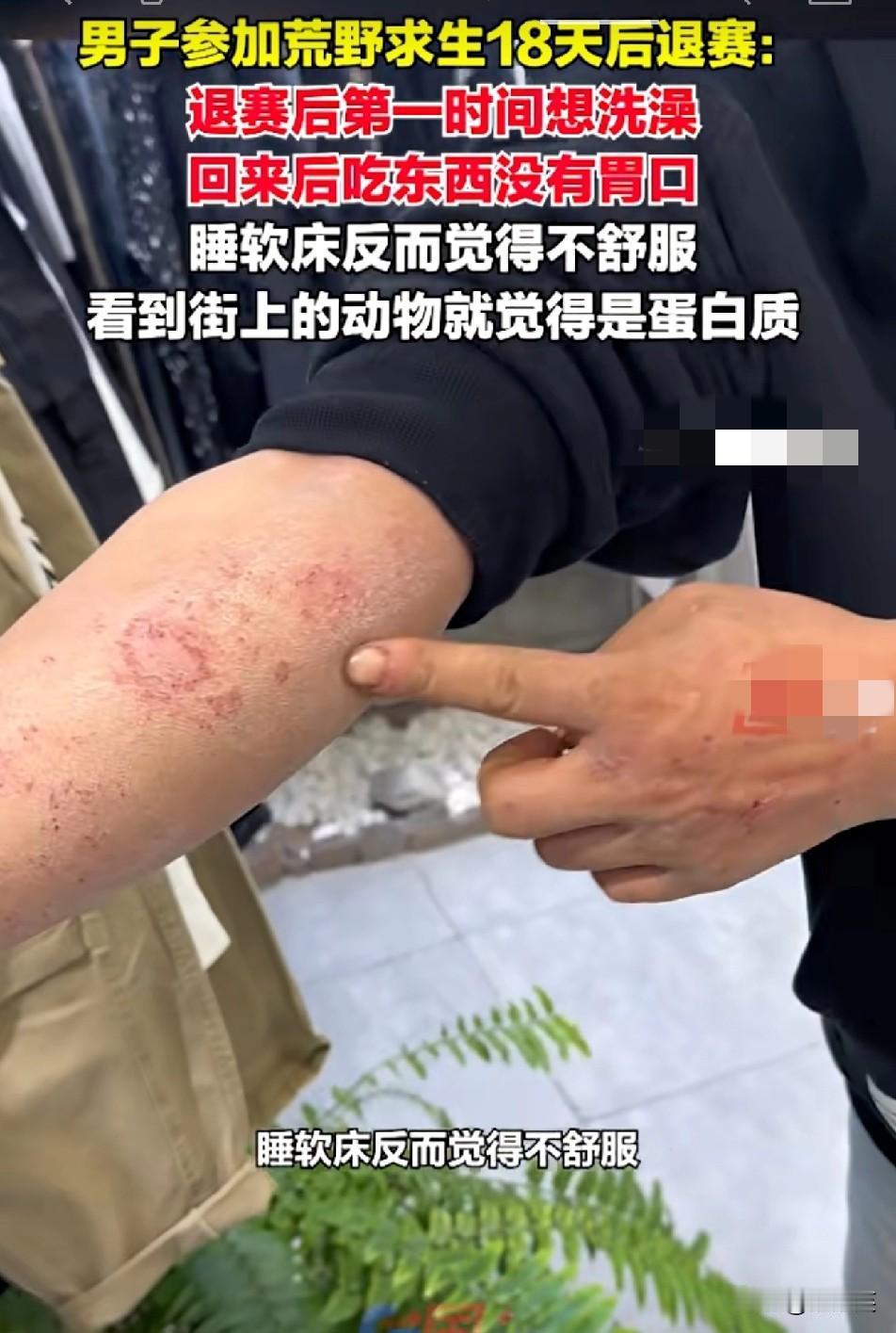 绝了

刷到这大哥的荒野经历我是真没想到

参加18天因眼镜摔坏退赛

回来后他