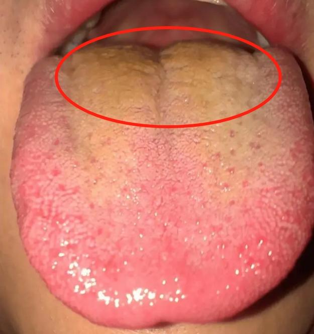 男人行不行，主要两点：一看舌根是否干净，二看舌边鼓不鼓？
 
就比如说这个患者