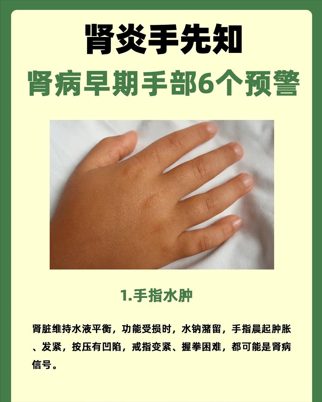 肾炎手先知，肾病早期的手部信号！
