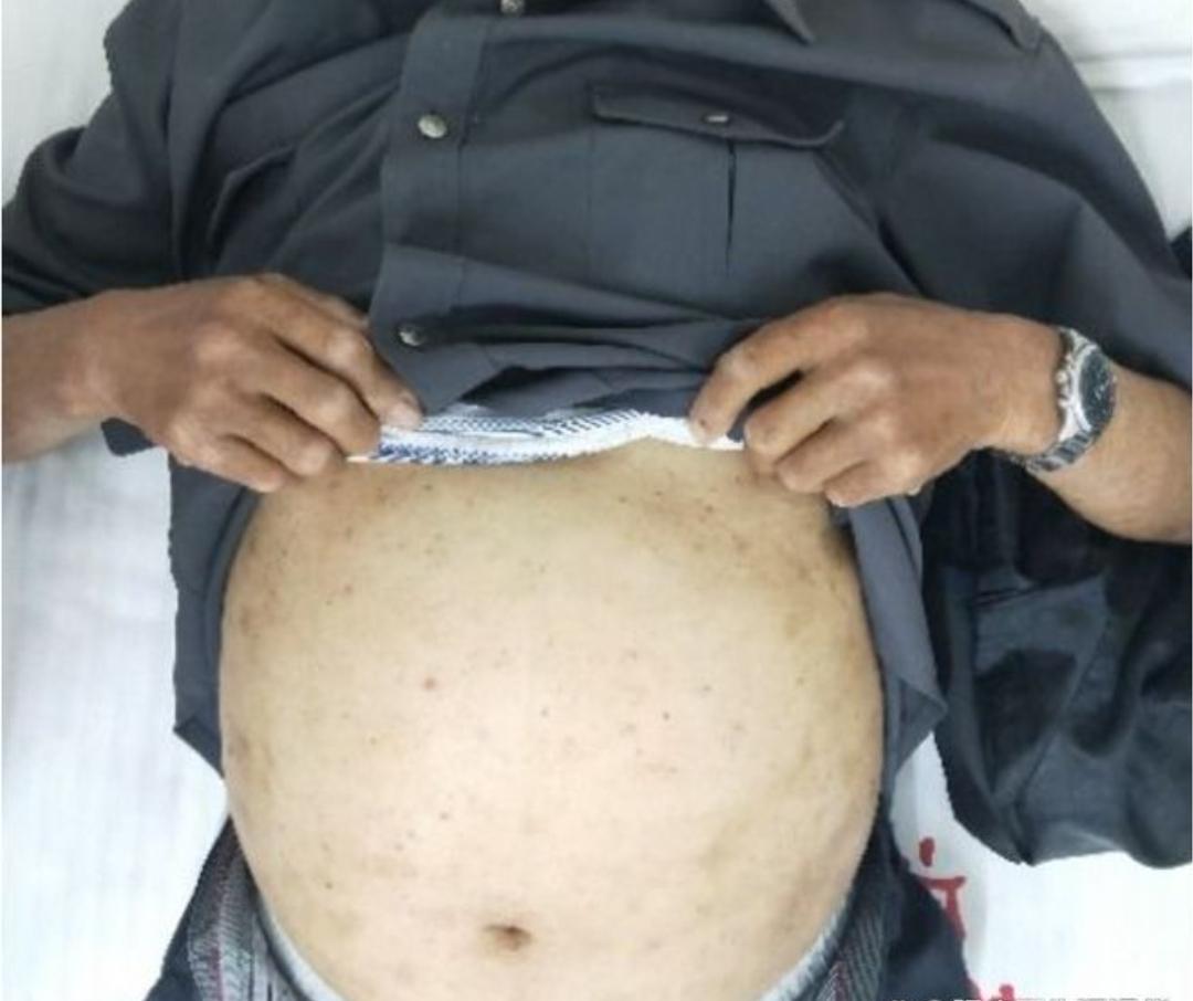 患者咨询：低蛋白、水肿、贫血、如何规范性治疗？
山东袁教授回复：首先这个问题问得很好，因为低蛋白水肿、腹水是肝硬化腹水里边咱们最为常见的临床路径，就是低蛋白它会导致胶体渗透压降低，因为我们知道我们血液能在血管内保持平稳的不管是静脉血还是动脉血，血管内的通畅，不往血管外边跑，不是光一个血管封闭的，它靠的是一个压力的控制，知道血管的压力里边一个晶体压、一个胶体压，晶体压靠的是什么？靠的是电解质、钾、钠、氯、钙，这是细胞的一个层面；那么胶体压靠什么？靠的是血浆、我们的蛋白，这就是胶体压，所以为什么说肝硬化