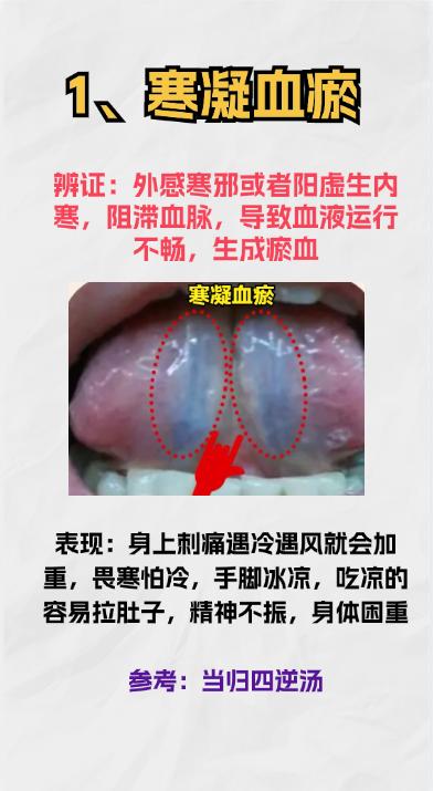 都是瘀血，病因不同，舌象也不大相同，调理方法一次全交给你！

#健康##中医##