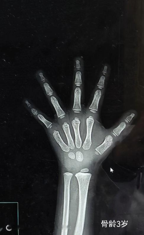 儿科门诊病历分享：男孩，6岁10个月，35个月前身高97.2厘米，体重14.4㎏