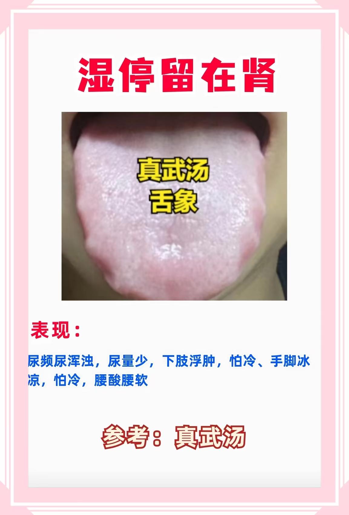 “湿在肾” 的核心逻辑（肾阳不足致水湿内停）和舌象、症状对应特别准！真武汤正是针