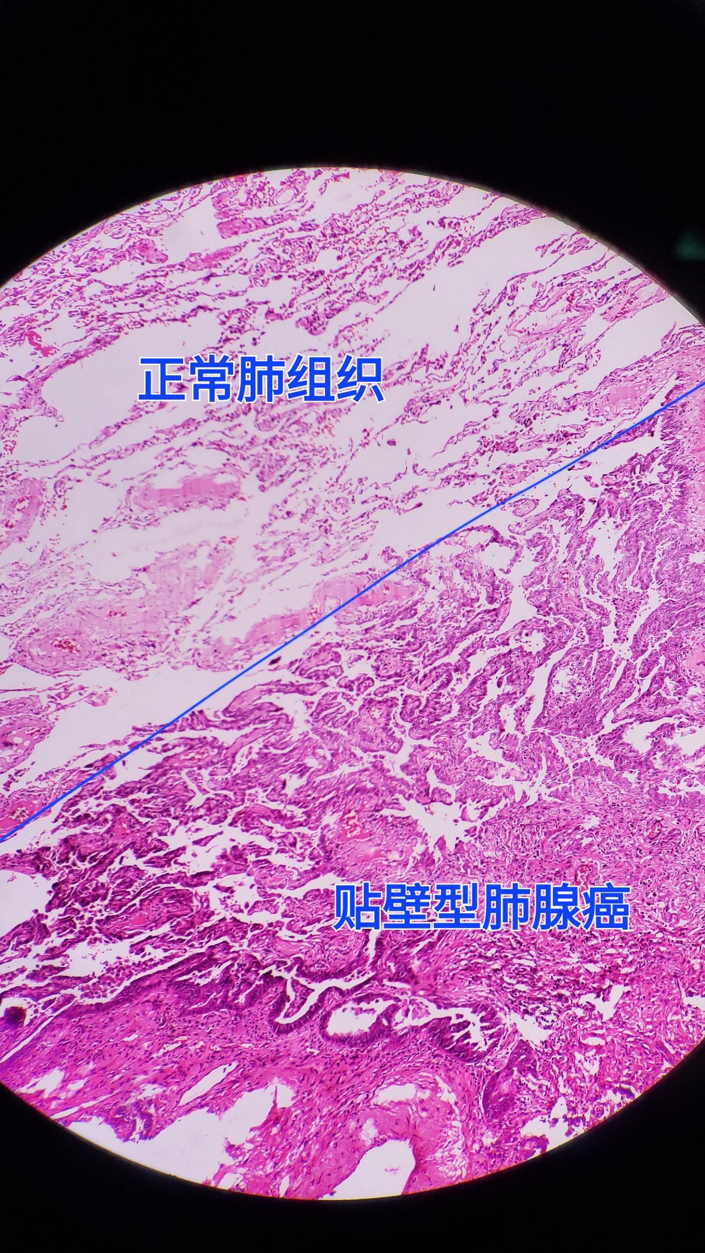 肺腺癌