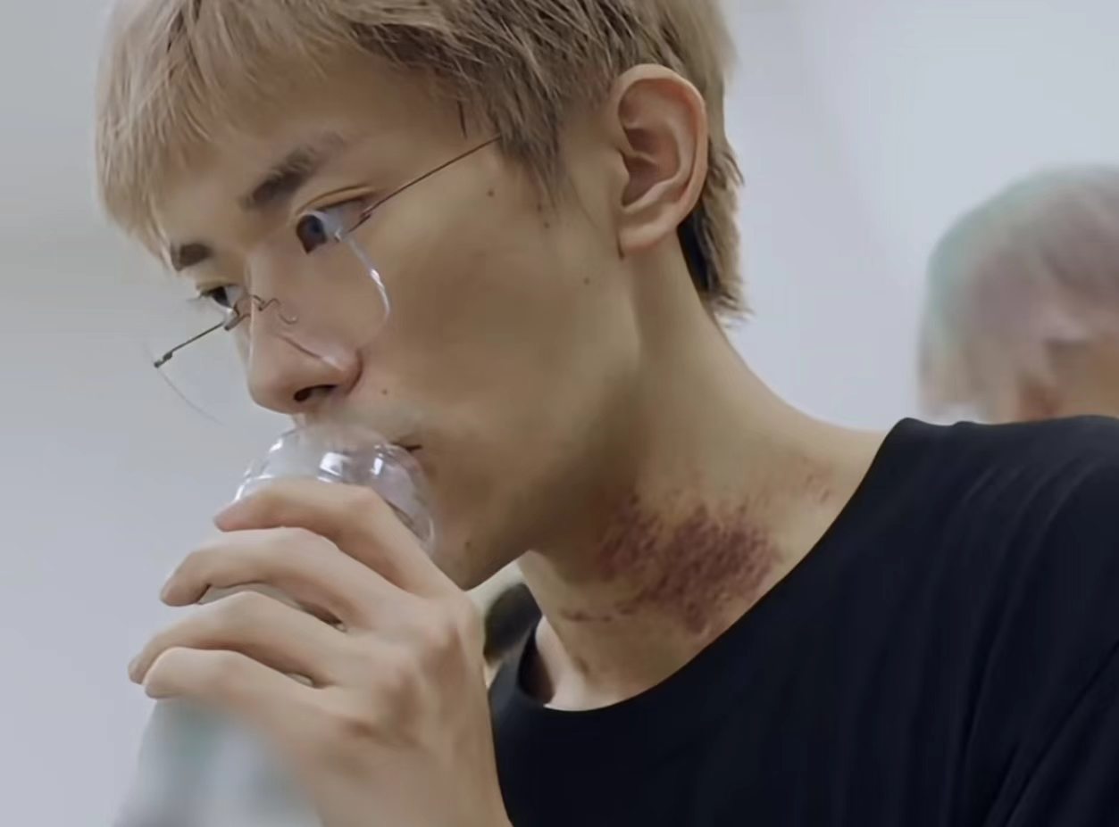 易烊千玺又给自己刮痧了易烊千玺又刮痧了  对自己好狠[捂嘴哭][捂嘴哭]易烊千玺