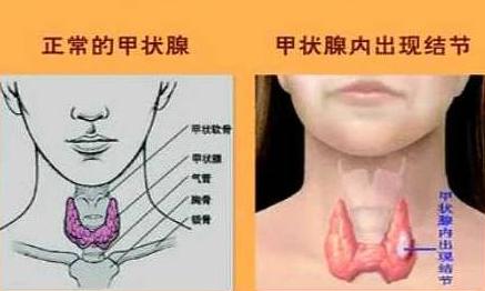 体检查出甲狀腺结节就等于判“癌”? 別再白慌了!
体检报告上出现“甲状腺结节”几