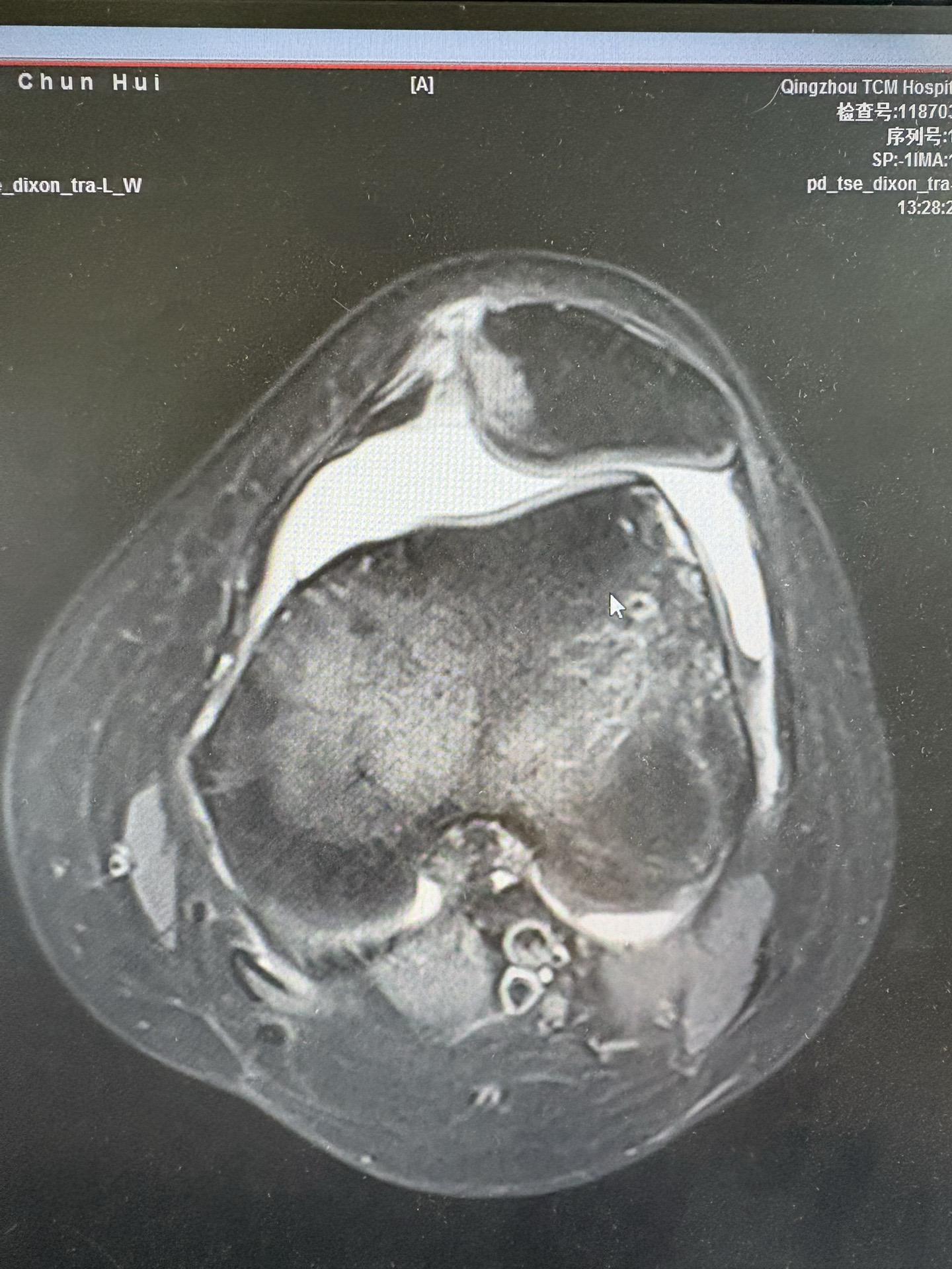 14岁女生髌骨半脱位术前术后对比，家属一直不愿手术，强烈要求保守治疗...