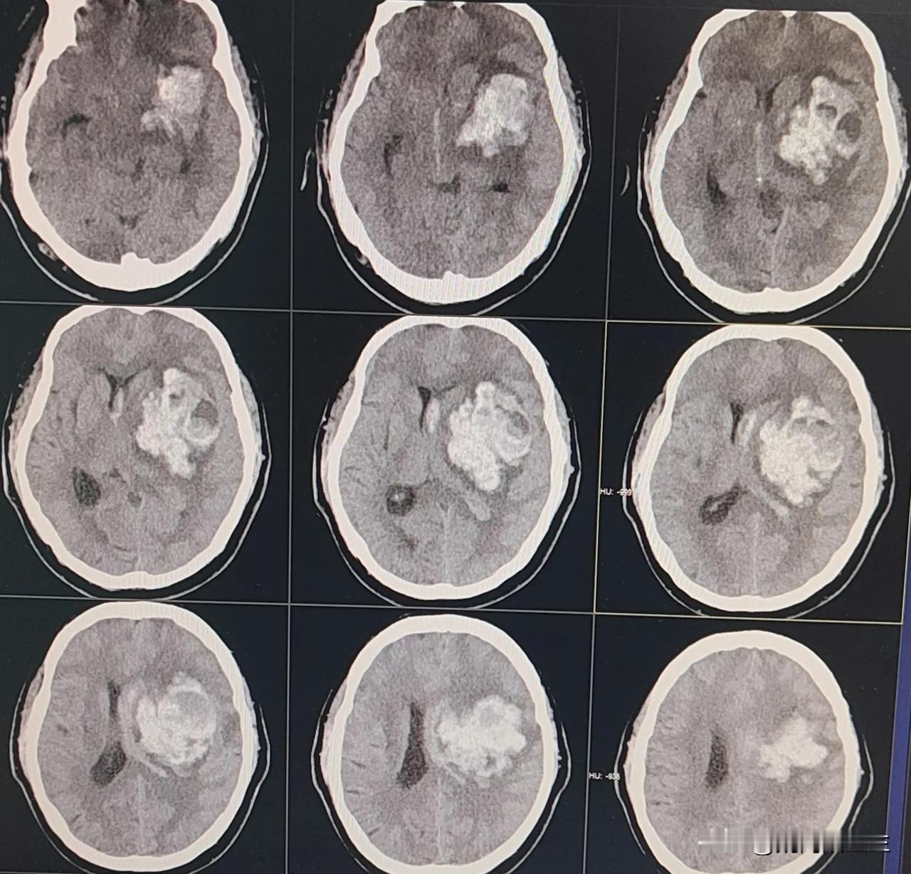 才30多岁，自己的同龄人
发现尿毒症两年。
这样的脑出血，
治好了也是偏瘫，
彻