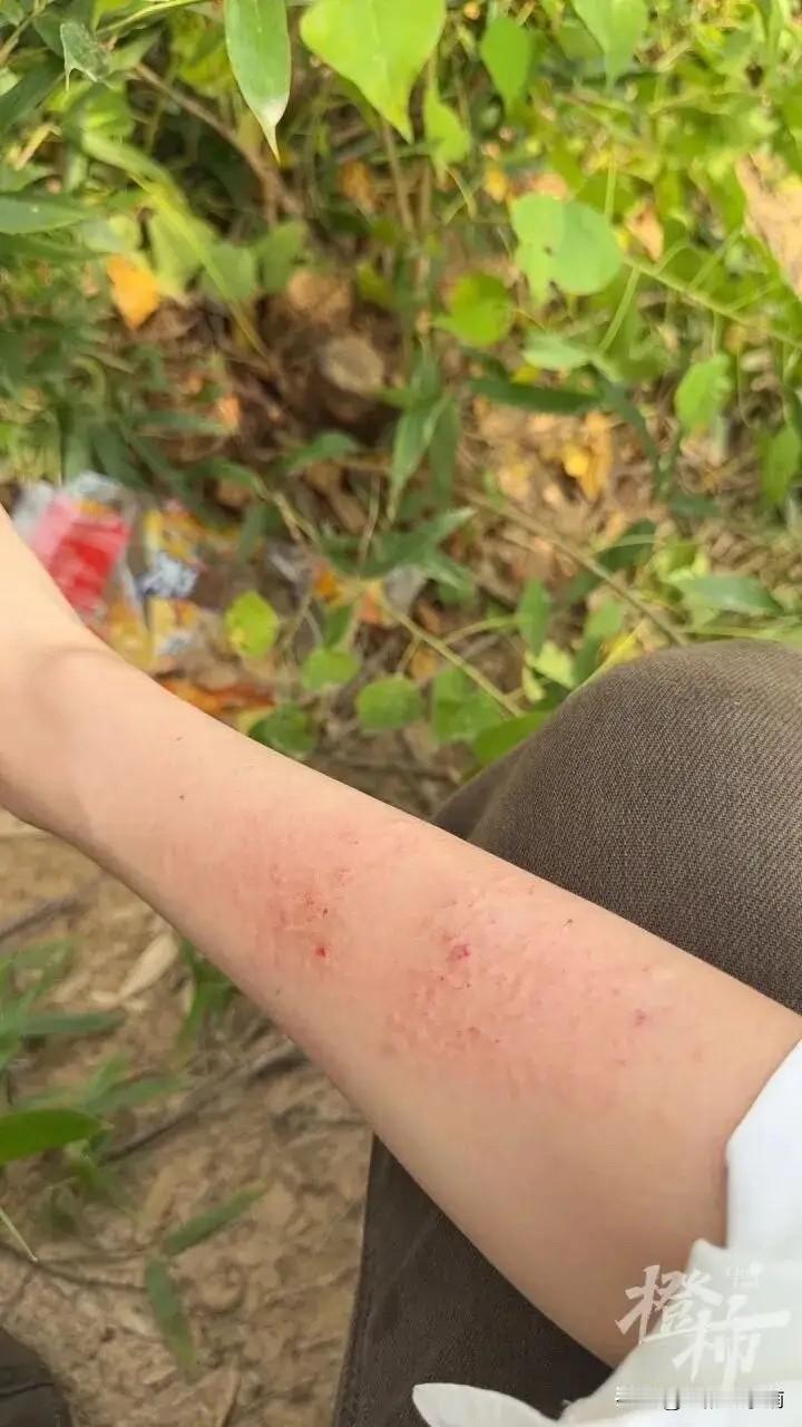 女子露营，板栗刺球掉下来砸中手臂，
浅的拔出来了，有4根在肉深处，
有网友教“滴