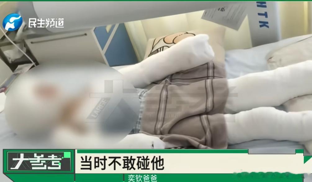 10岁男孩烧杨絮引爆油桶特重烧伤看得心口揪紧，又气又心疼！每个孩子都是爸妈捧在手