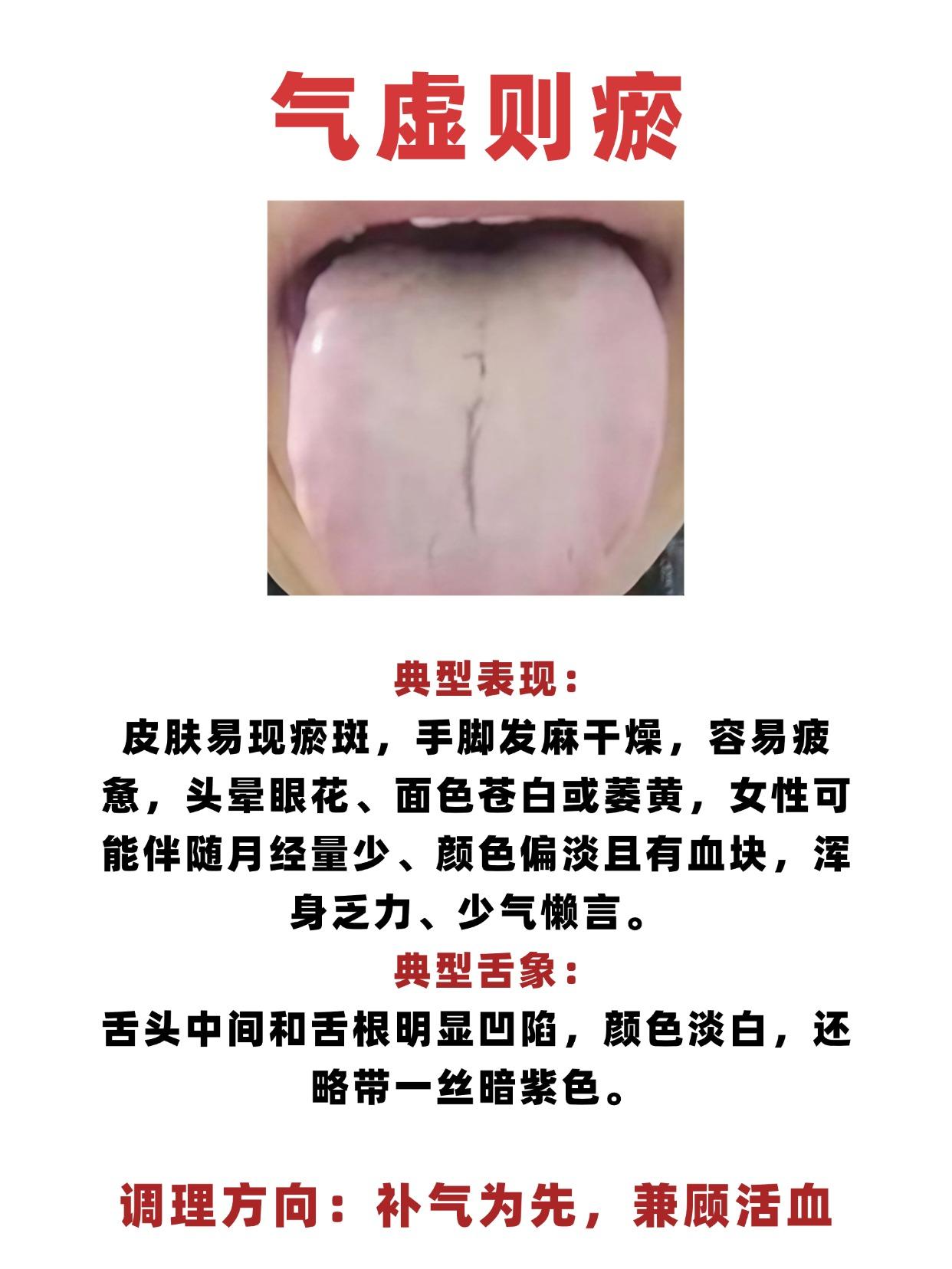 气虚则瘀，气滞则堵，气逆则胀。看这3个舌象就明白了。