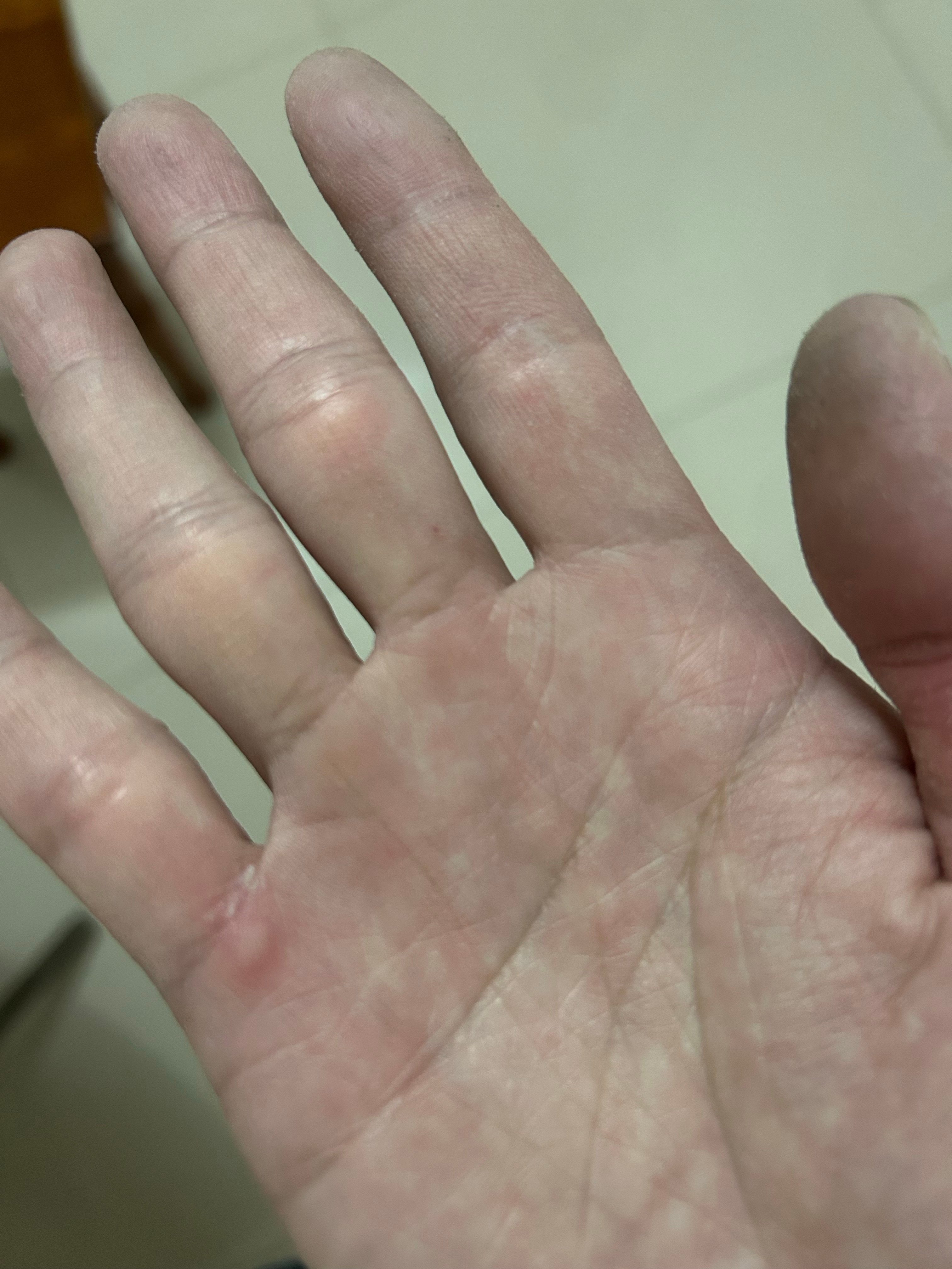 工地干活三个星期，留了不少疤，但睡眠真的好，我在考虑下周要不要复出