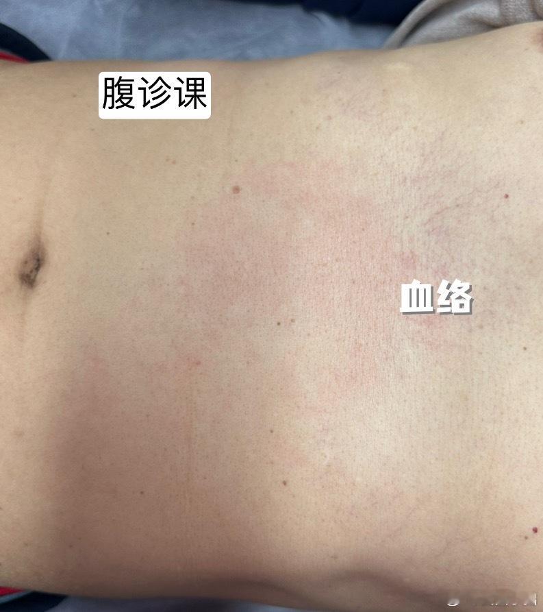 这期学员有位大哥得了冠心病，医生说，要一辈子吃药了。大哥不信，开始自己调理。断了