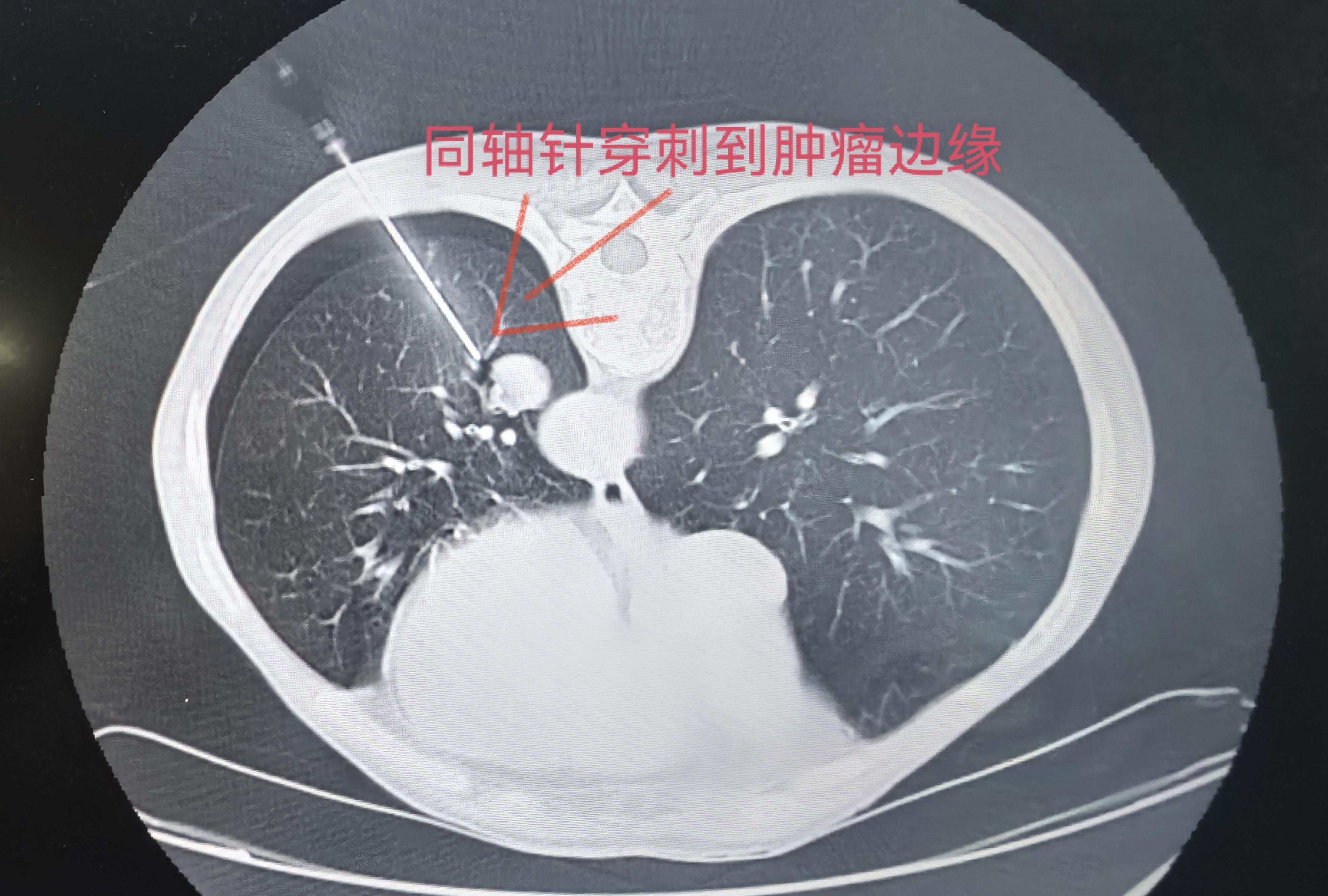 一例肺转移瘤微波消融：  3天前一台直肠。一例肺转移瘤微波消融：   ...