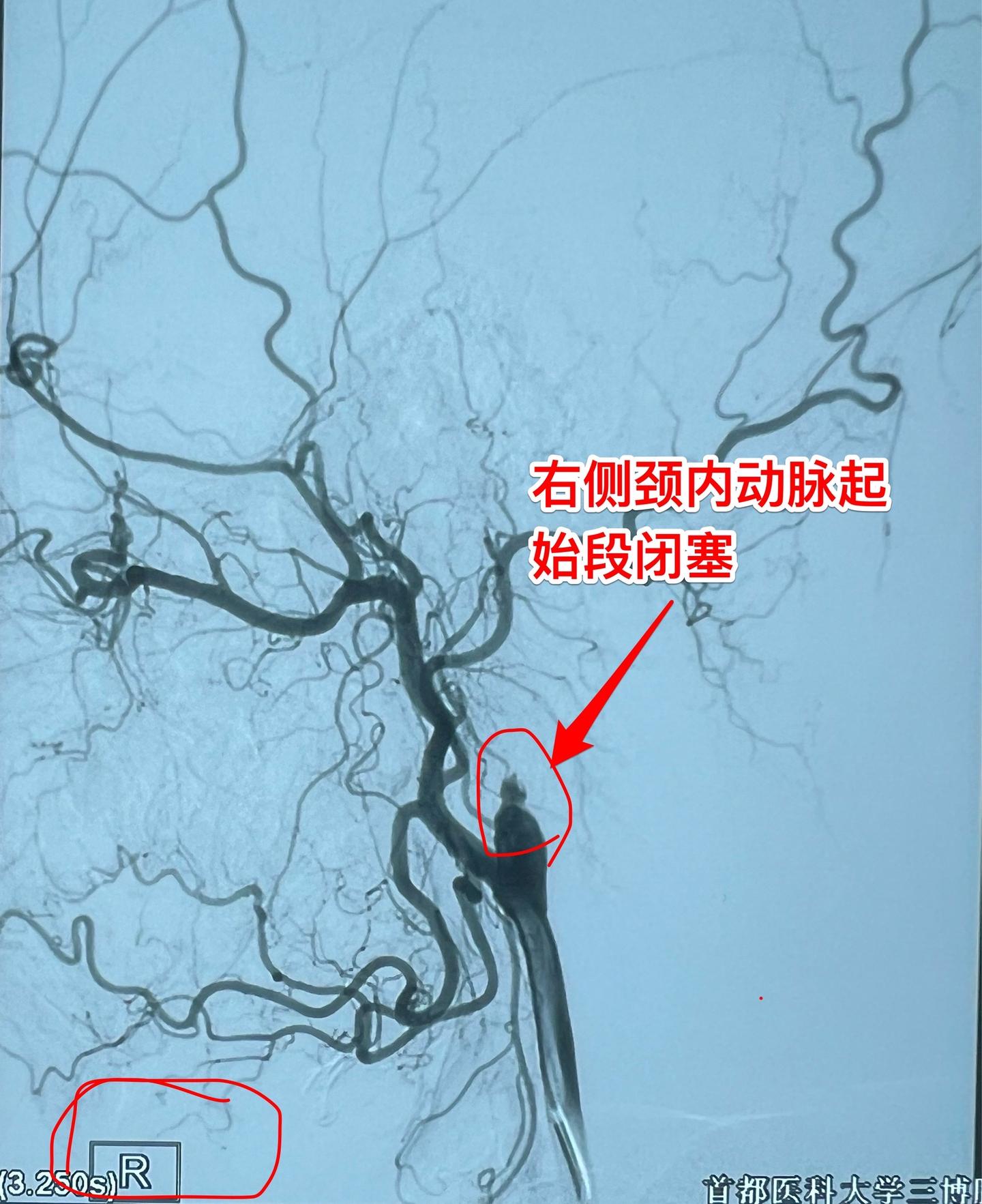 在烟雾病基础上合并后循环的动脉瘤。55岁佳木斯市女性，近三个月在北京生...