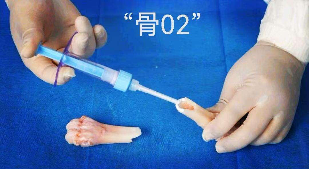 有谁听说过骨折了用胶水一粘就好了吗？现在应用 “ 骨02 ”黏合技术，可以在短短