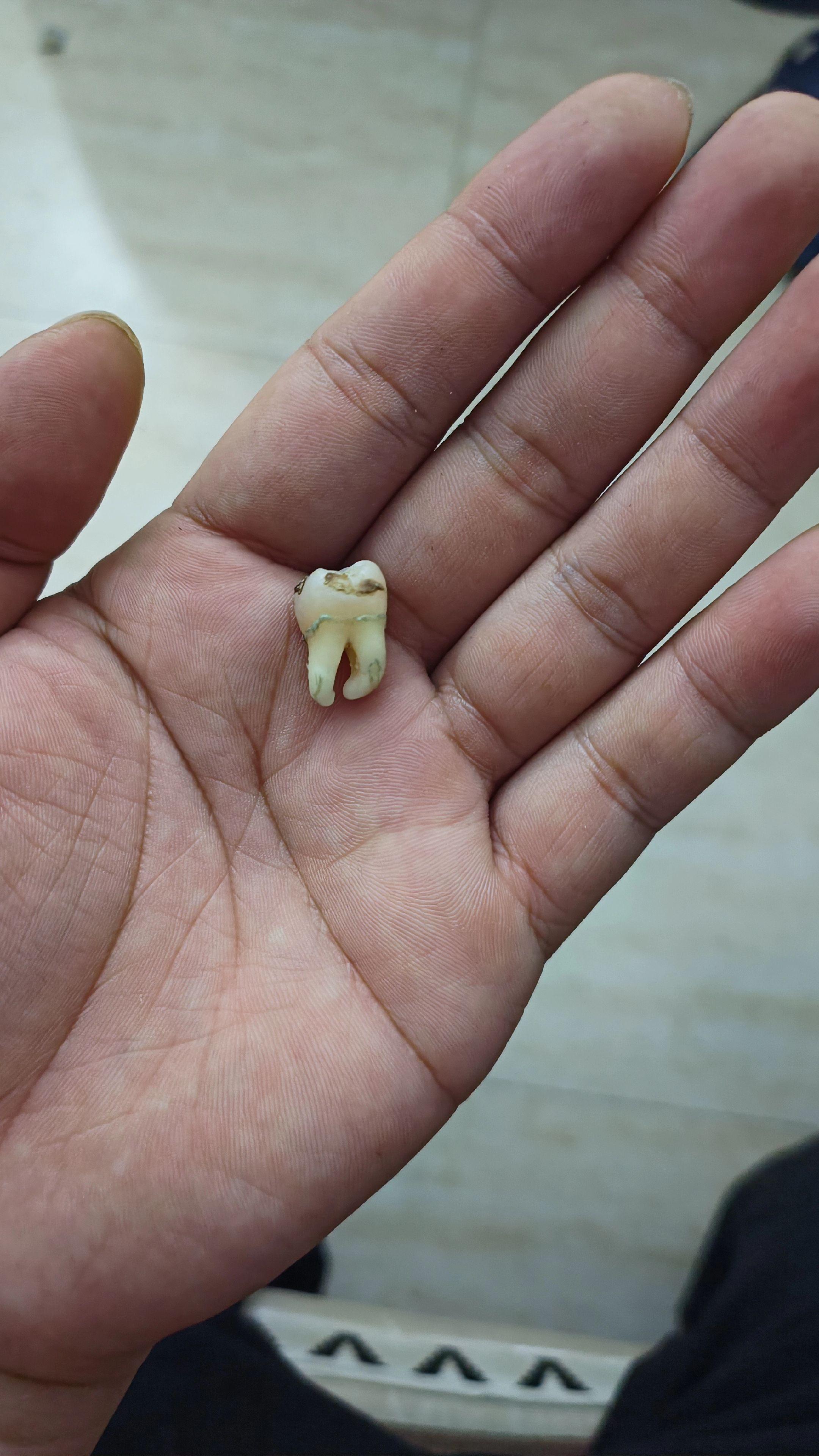 终于把这颗智齿拔了。智齿疼了几年终于把你拔了。。。