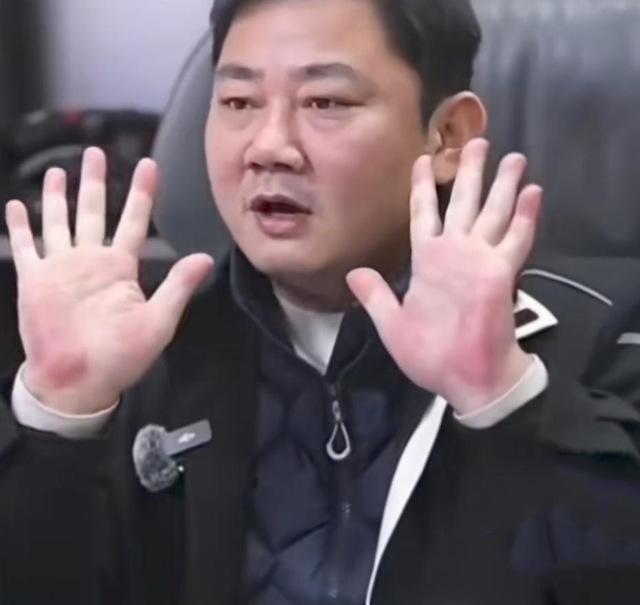 张雪的红手掌，引起很多网友的关心，大家纷纷建议他及时去检查身体，甚至还有医生博主