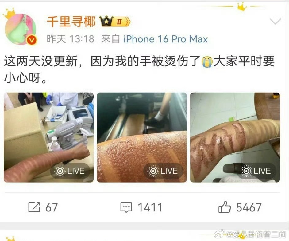千里寻椰 光子嫩肤二度烧伤好好的变美项目搞成这样，还可能留疤。果然医美得认准正规