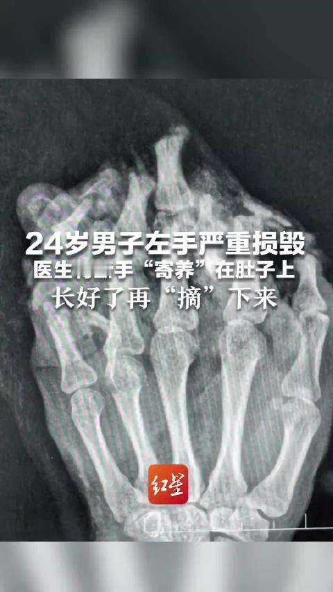 太震撼！东莞24岁工人手被机器压伤，医生竟把他的手“种”进肚子里养着
谁看了不惊