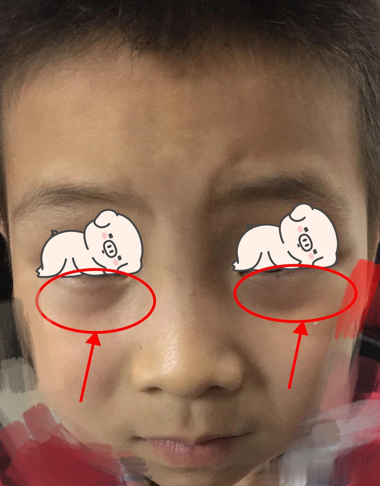 小儿鼻炎反复发作，对根治疗，寒、浊排出来了，病就好了！
 
门诊之前有个7岁的孩