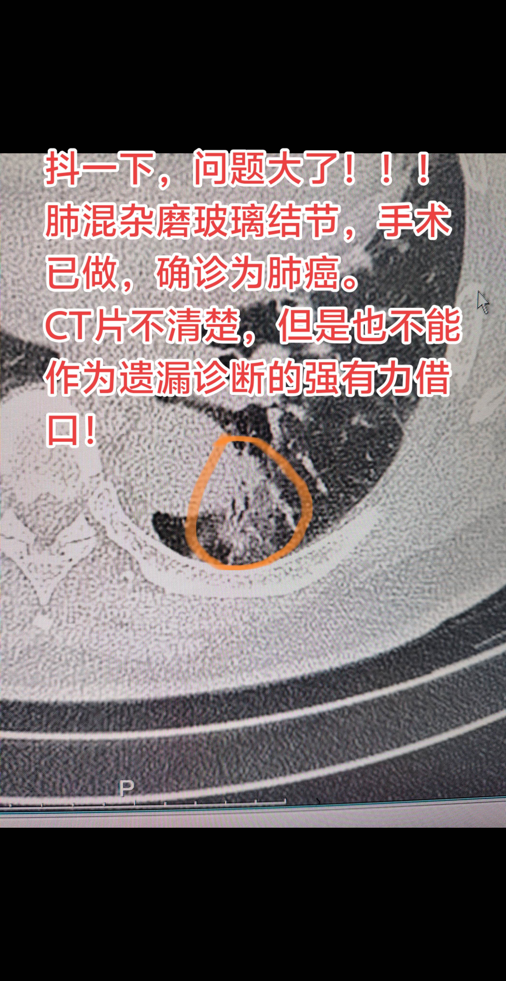 抖一下，可能问题就大了⚠️。查出肺混杂磨玻璃结节，已经做完手术了，结果...
