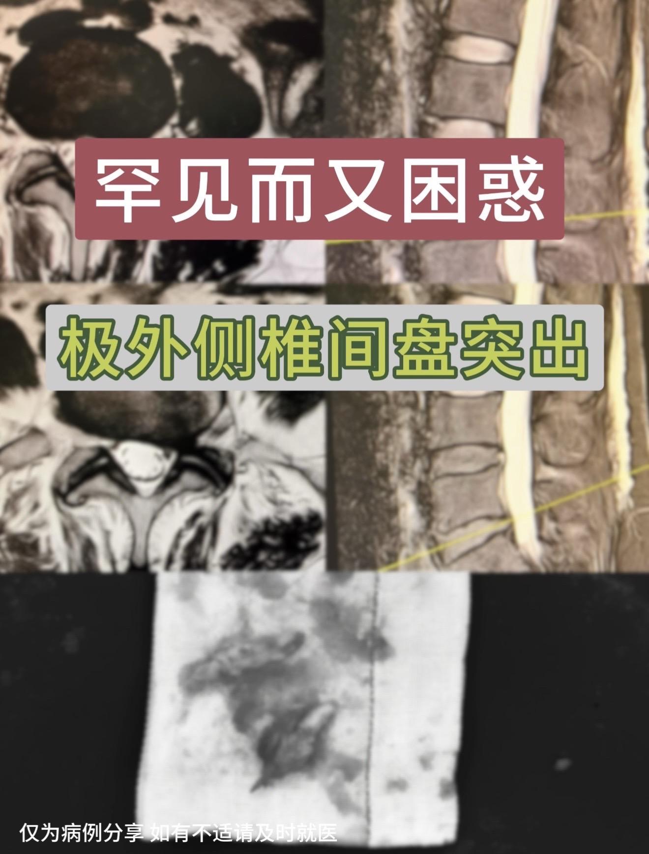 罕见而又困惑的极外侧椎间盘突出症患者。女性，50多岁，腰疼伴左下肢疼痛...