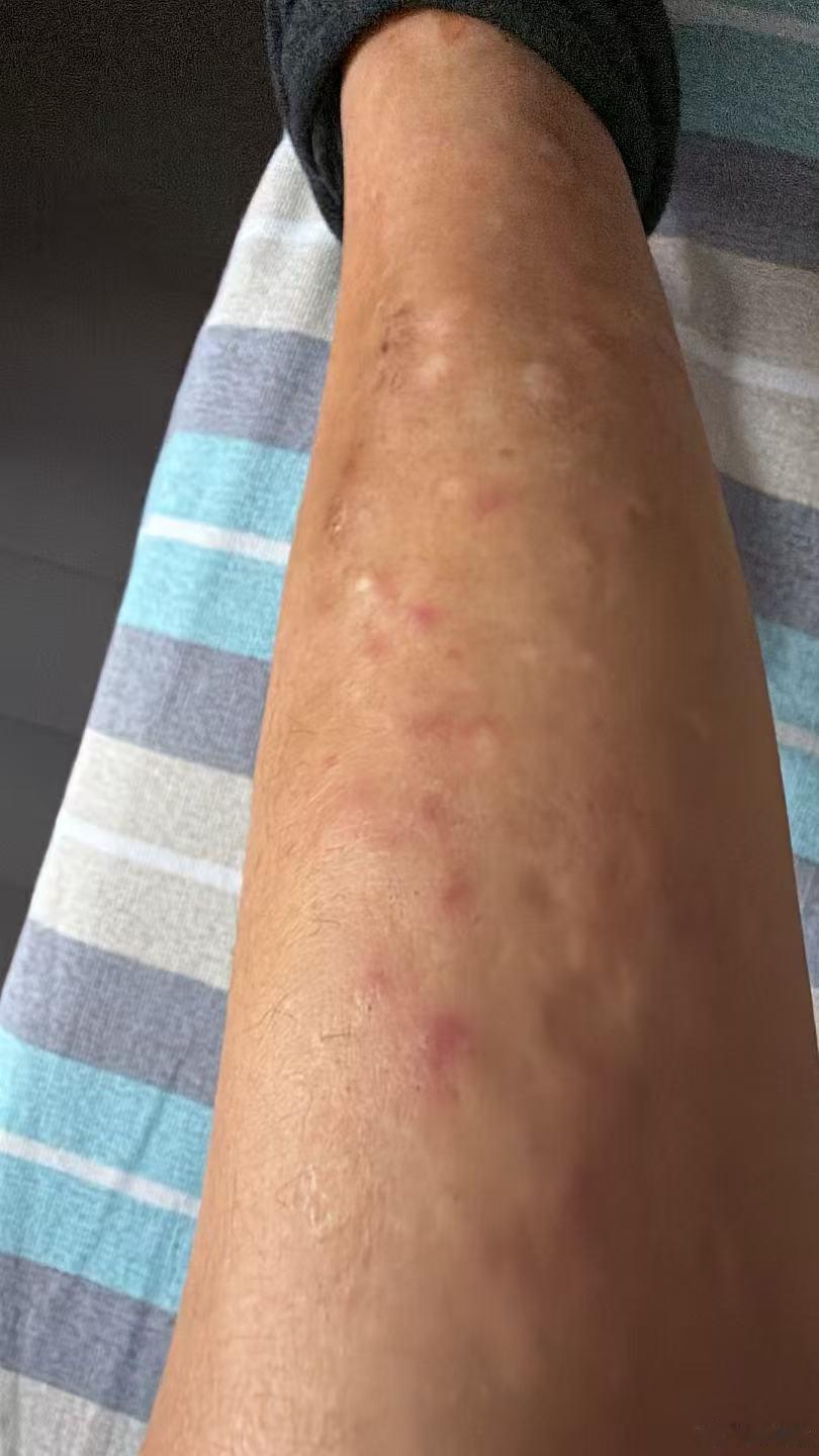 一个干癣，被当成湿疹，一味的热药艾灸刮痧，局部都出血了，痒的不行，人也津血亏虚，