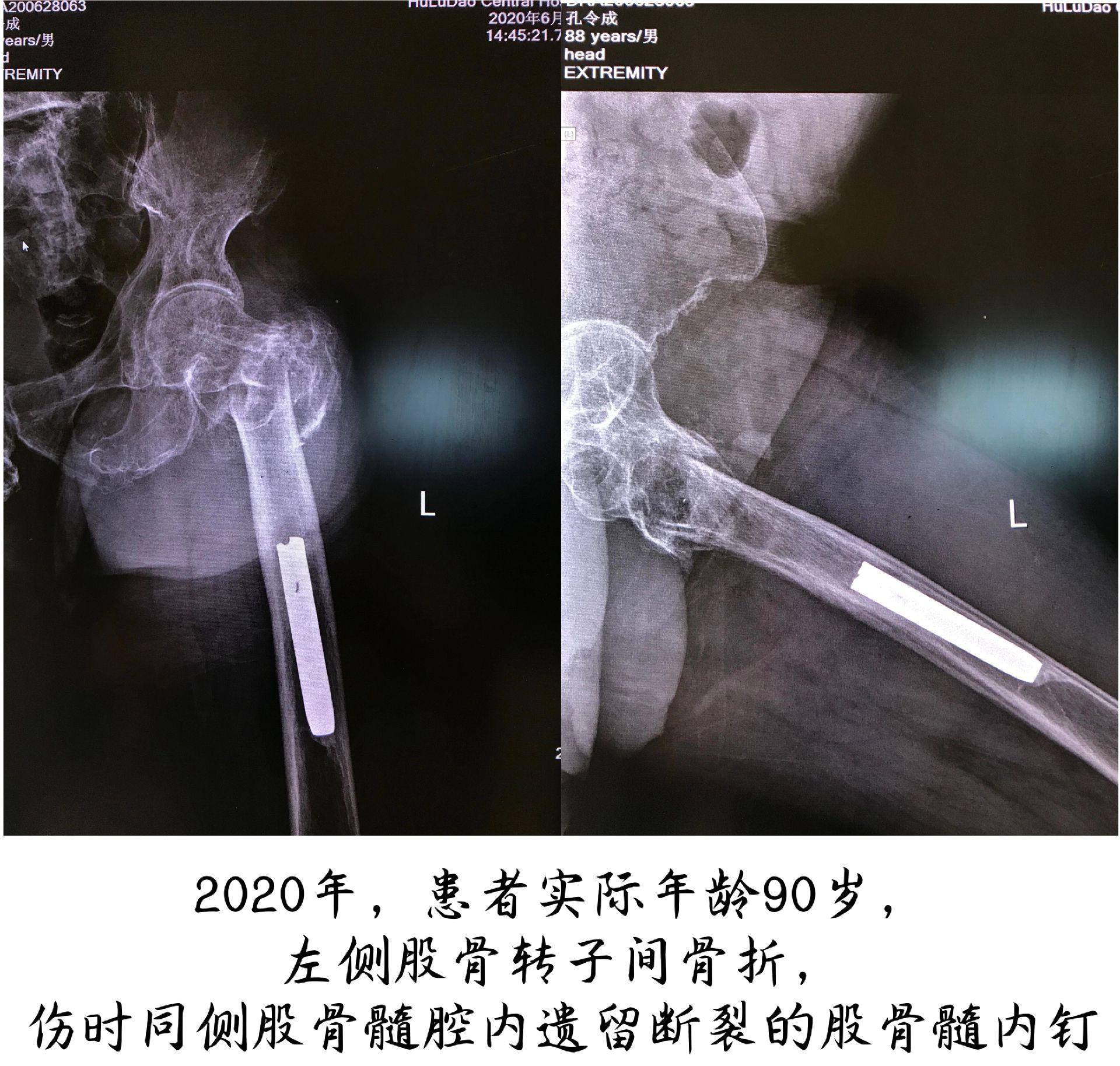 从2020年到2024年，从90岁到94岁，老人家先后摔伤导致双侧髋部骨折，分别经历了股骨开窗髓内断钉取出术、人工关节置换术、转子间骨折闭合复位PFNA固定术。术后又见到了老爷子的笑容，希望老人家预后良好，长命百岁！葫芦岛市中心医院连山院区创伤骨科将竭尽全力推动老年髋部骨折的MDT治疗！
分