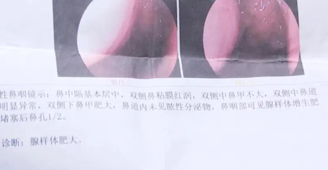 腺样体肥大怎么来的就让它怎么回！李医生说。我一直在平台上和大家分享关于腺样体肥大、过敏性鼻炎的一些科普视频。
也受到了很多家长们的关注，家长们也很重视腺样体肥大这个问题，其实我想和大家们说的是，腺样体与生俱来，随身体的生长发育而逐渐增大，一般来说，2-10岁为腺样体生理性增生期，6岁左右体积最大，10岁后逐渐萎缩，青春期前逐渐消失。
一般急性炎症期腺样体肿大，当急性炎症消退时，腺样体随之恢复至原来的大小，若因某种原因，腺样体持续肿大，影响邻近器官及身体健康，称为腺样体肥大。
由于腺样体位置隐蔽，其发病极易和