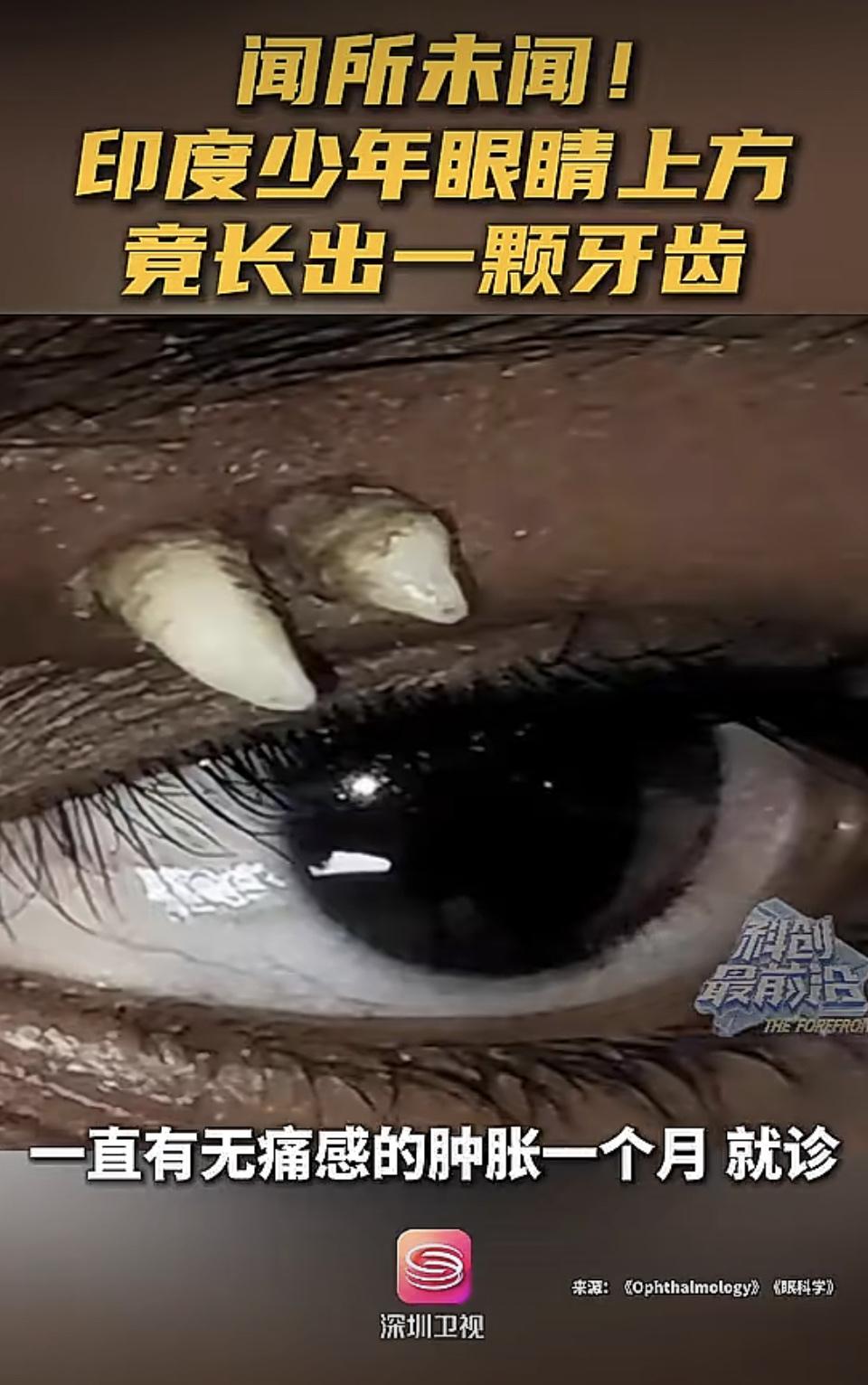 眼睛为什么会长在眼皮上？莫不是什么天罚吧。如果长了后眼睛