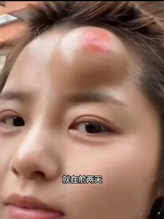 普通人如果遇到冰雹，一定要保护好头部，否则最起码会出现两个包，鸡蛋大的冰雹没有保
