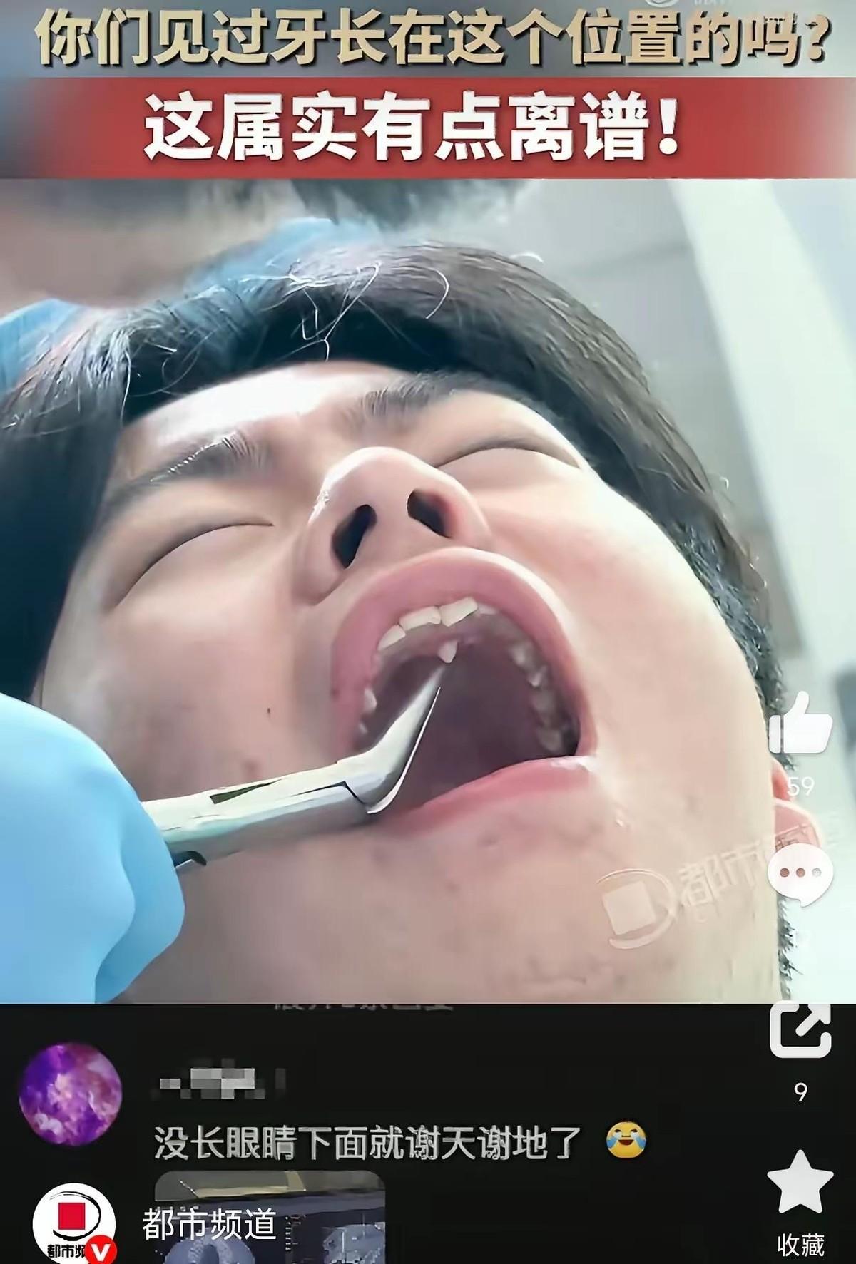 河北小伙牙疼就医，竟在上颚发现一颗“鲨鱼牙”，拔牙时自己都哭笑不得。当时他躺在那