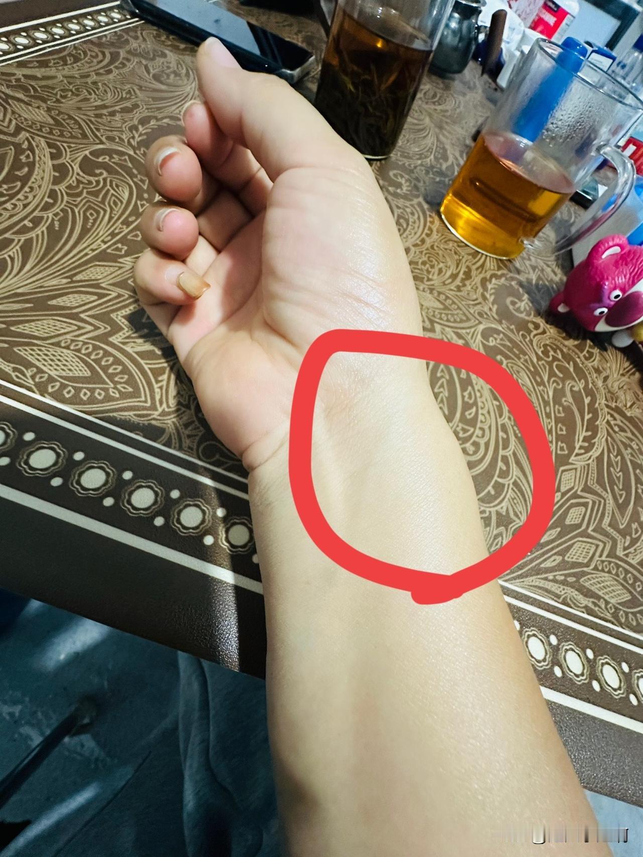 晚上11点打完包，都放进冰箱。
坐下给手腕涂药。
看着鼓起来一个硬包的手腕我说：