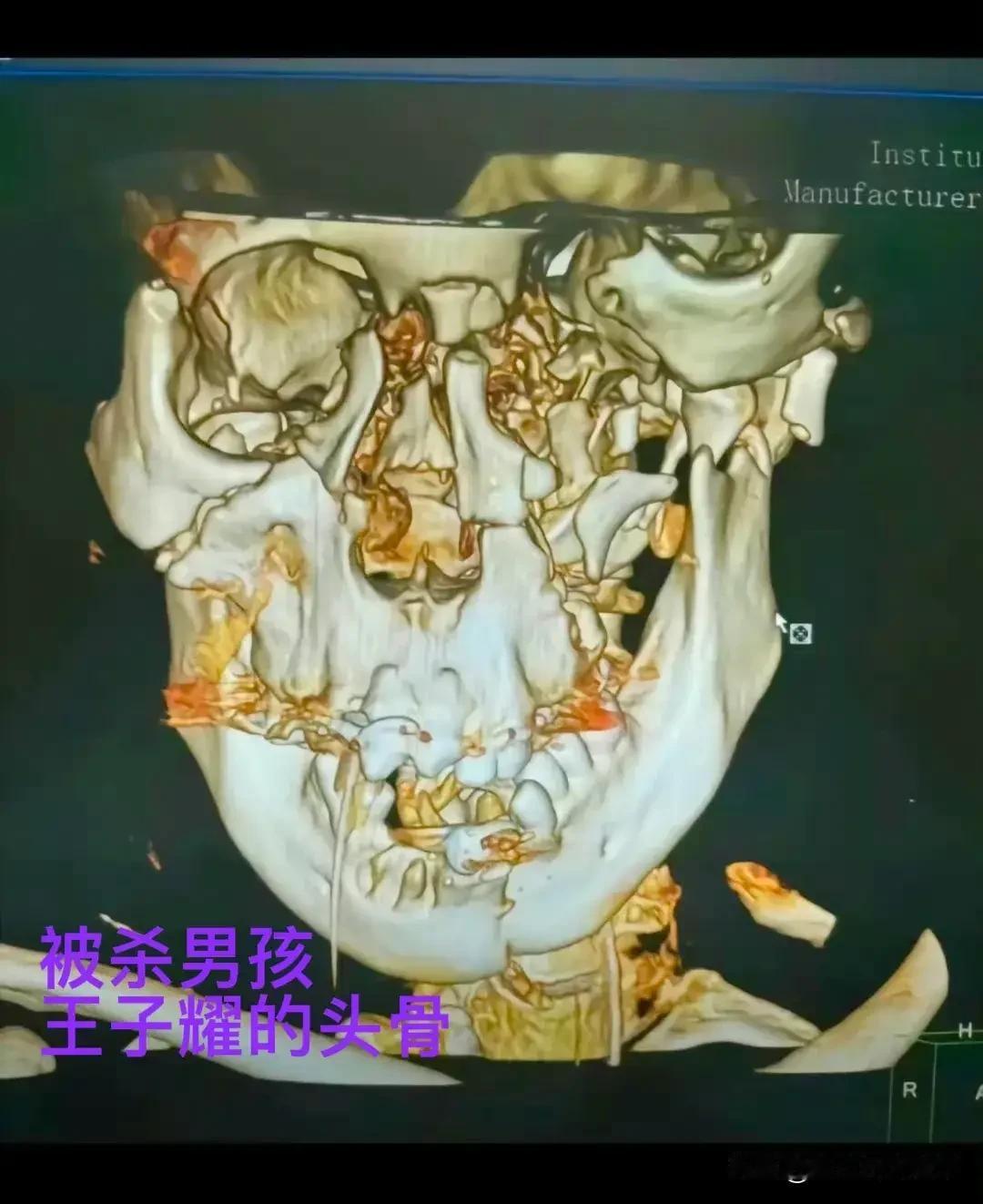 邯郸初中生可能被活埋，案件再现重大疑点
        近日，邯郸三名初中生杀死