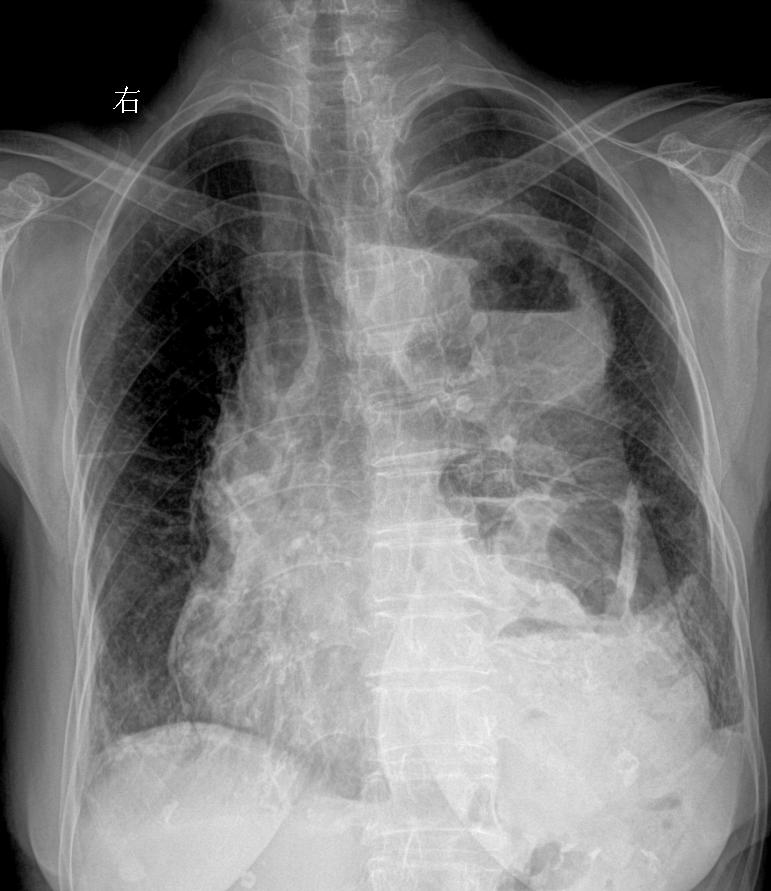 食管癌术后 胸闷就诊 女89岁