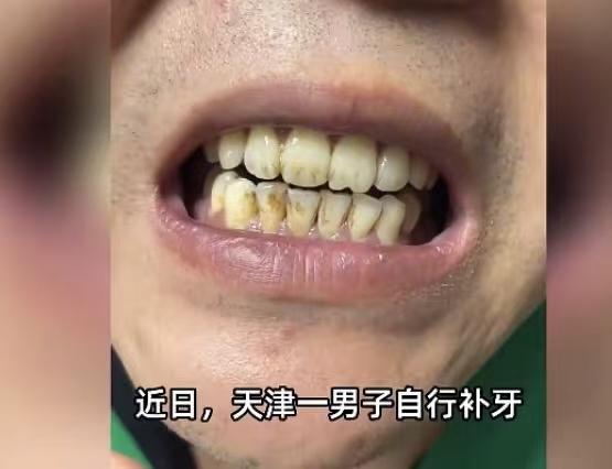 看到这一幕，真笑不出来！

天津一位大叔，为了省下补牙的钱，在网上花了5块钱购买
