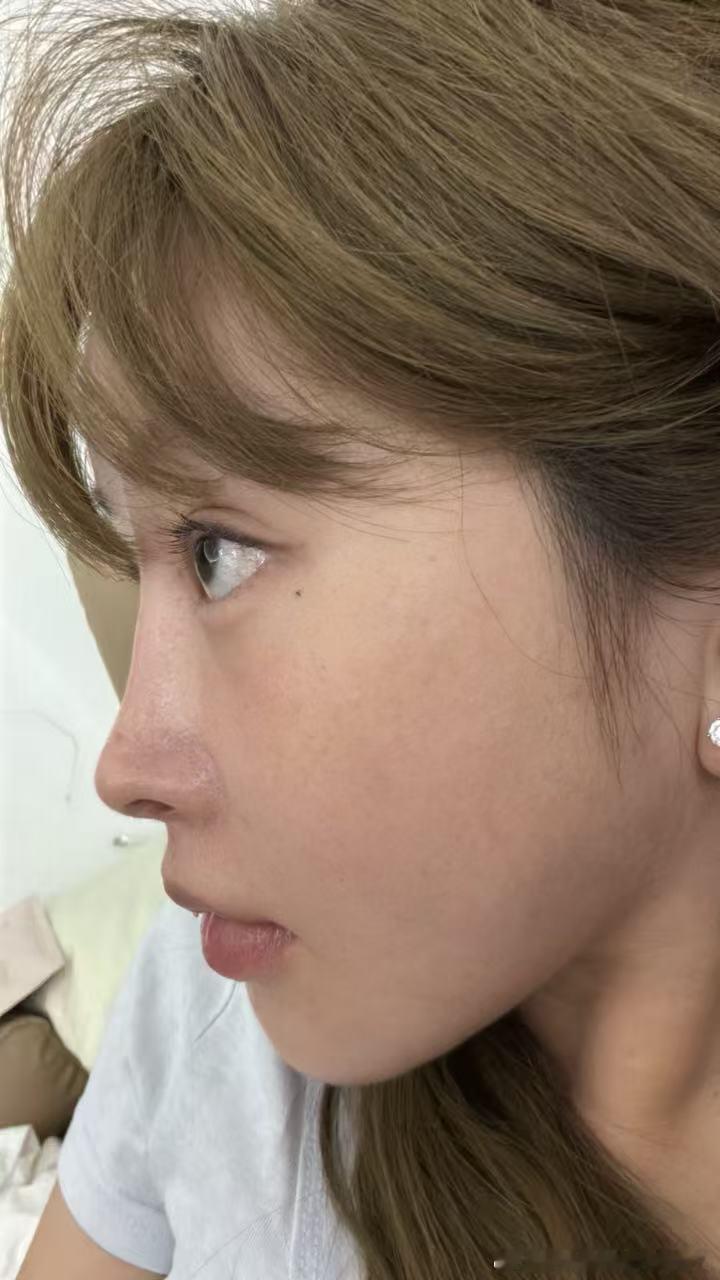 植完头发后 鬓角那里头发疯狂生长 