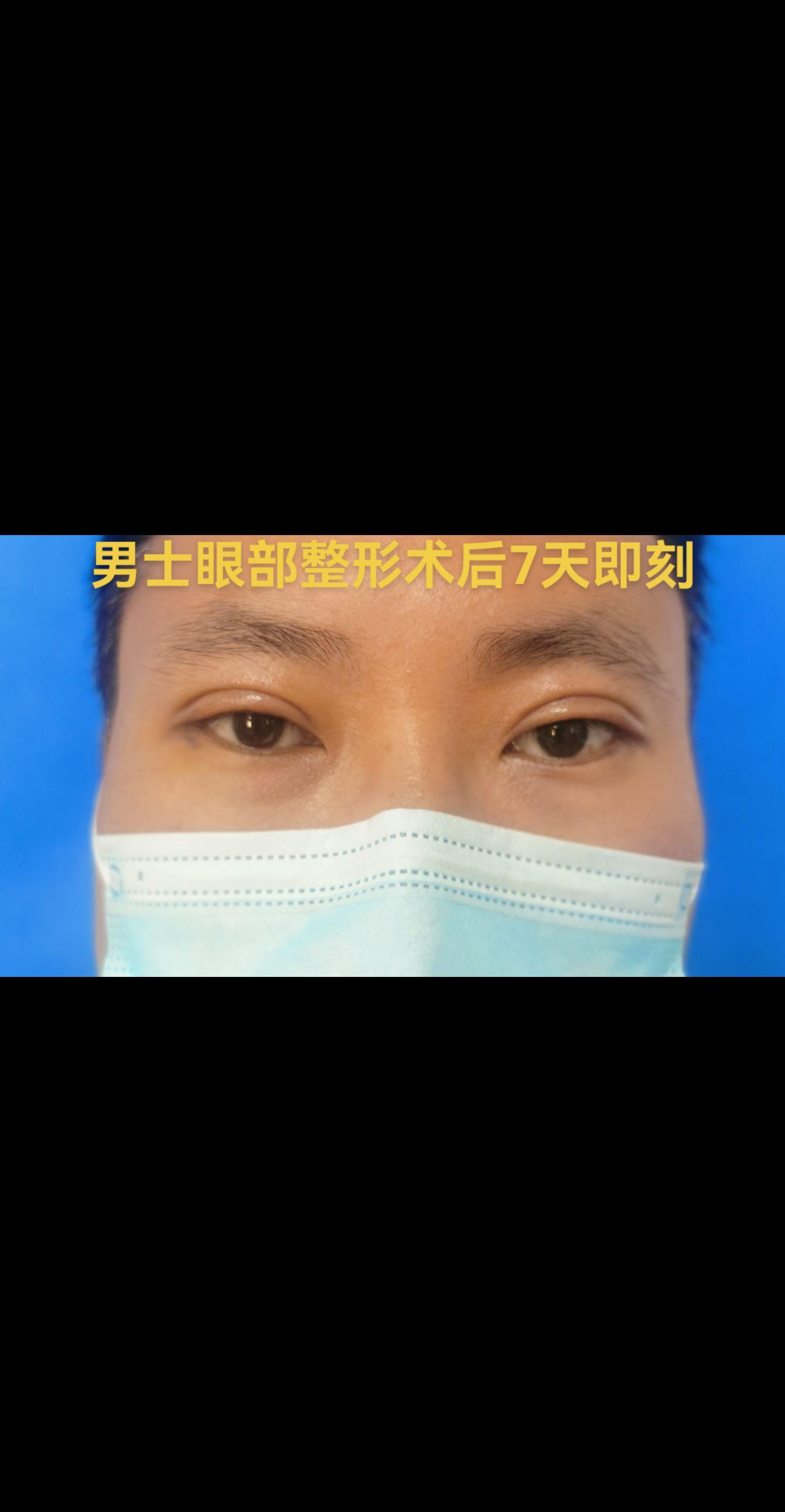 中年男士眼部整形。中年男士眼部整形术后7天拆线后即刻。