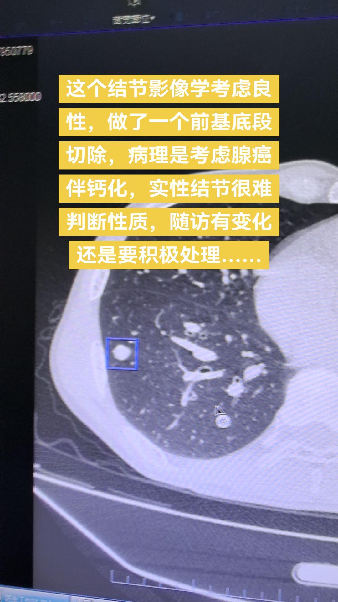 这个结节影像学考虑良性，做了一个前基底段切除，病理是考虑腺癌伴钙化，实...