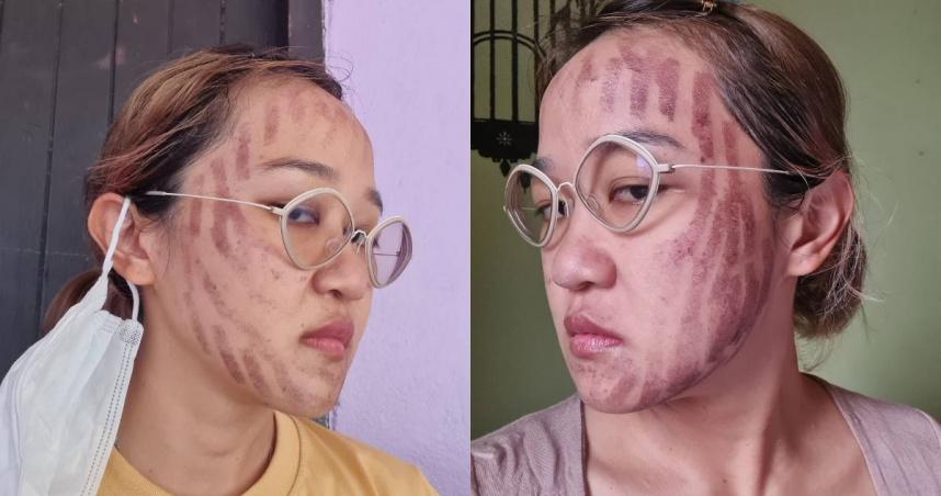 泰国一名女子日前到曼谷一家进行激光脸部护理后，脸颊不断出现刺痛感，而经过数小时后