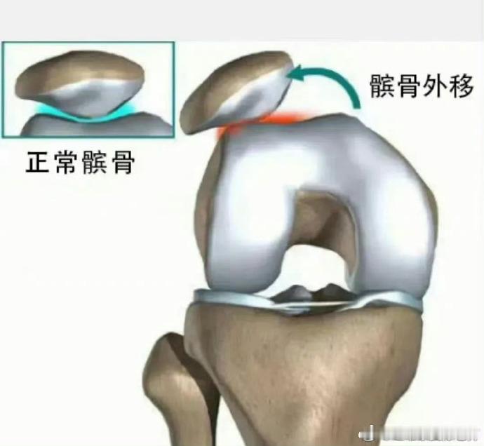 膝盖疼痛可能是软骨磨损了  髌骨软化是我们线下最常见到的一种疼痛损伤了，今天再讲