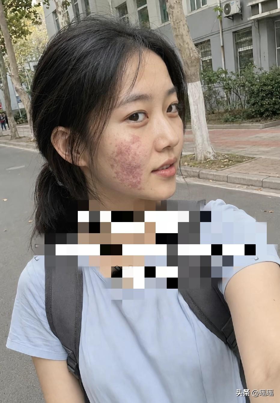 即使有胎记，也不影响你精致的五官
