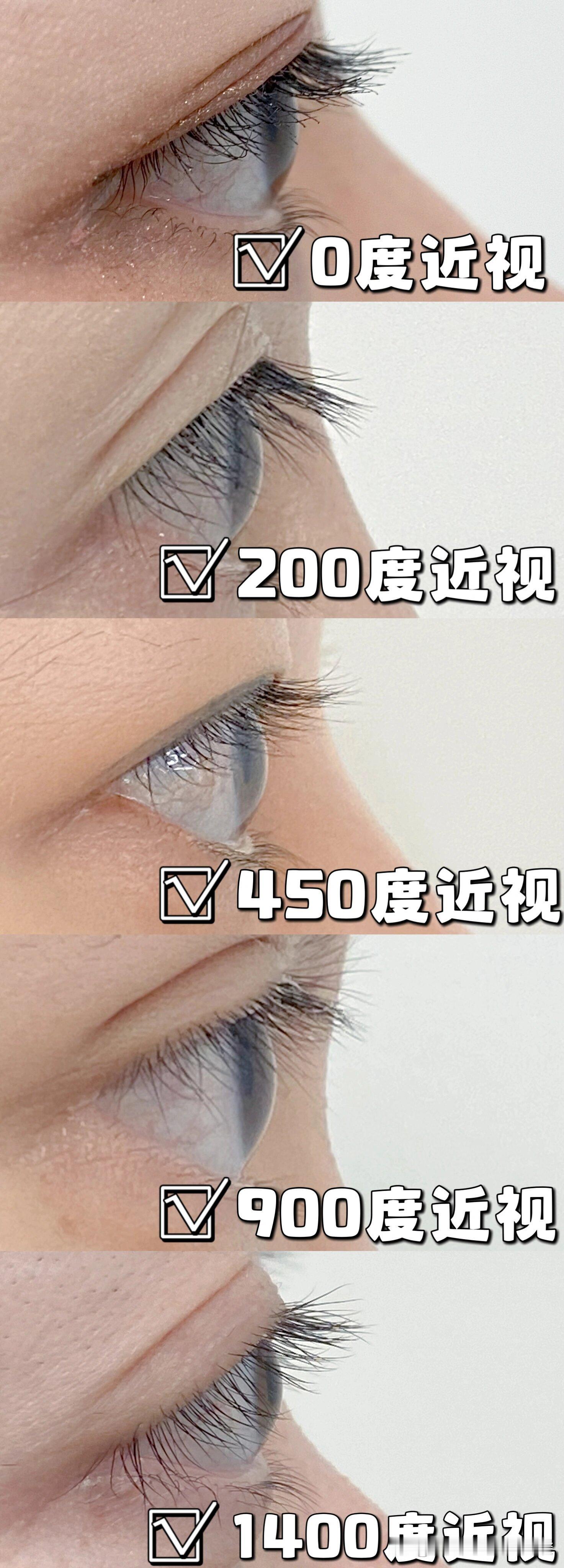 眼睛度数降了100度 做为一个近视几十年的高度近视的人来说，这些方法都知道，也试