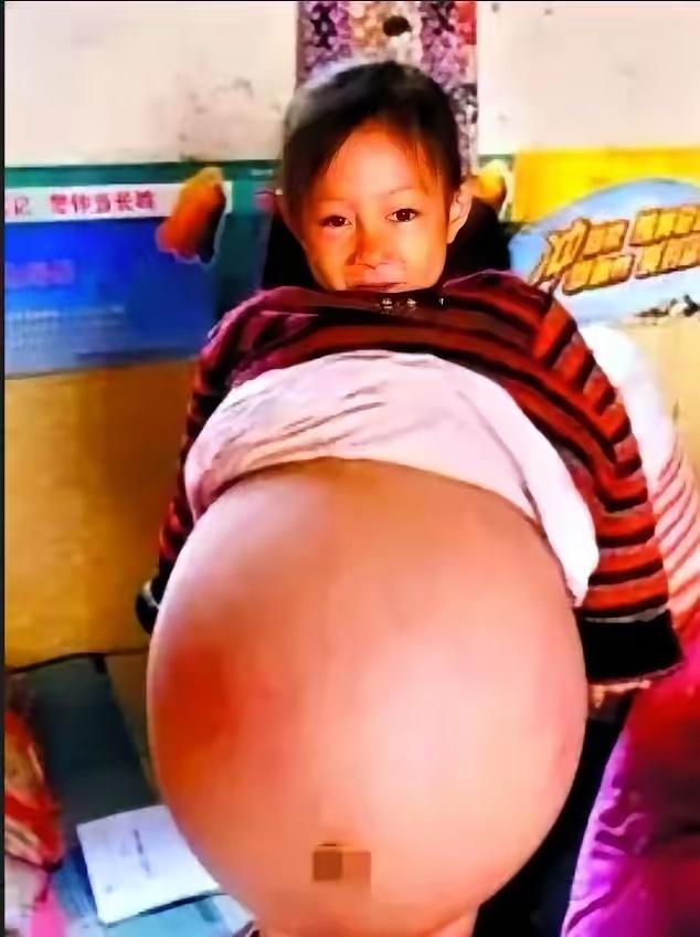 4岁女孩肚子鼓得像孕妇，医生判“活不过3个月”，救她的竟是对门一句闲话

201