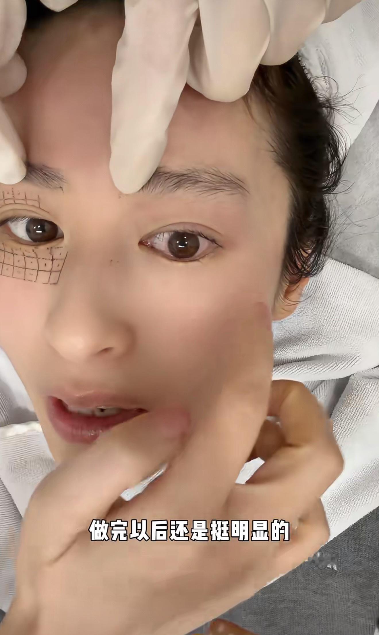 颖儿做眼部热玛吉疼哭了看颖儿做眼部热玛吉这段隔着屏幕都感觉好疼，女演员为了美真的